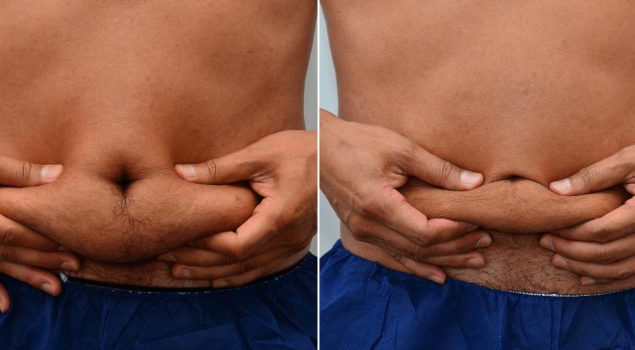 La cryolipolyse : le soin minceur pour bien démarrer la nouvelle année ! 